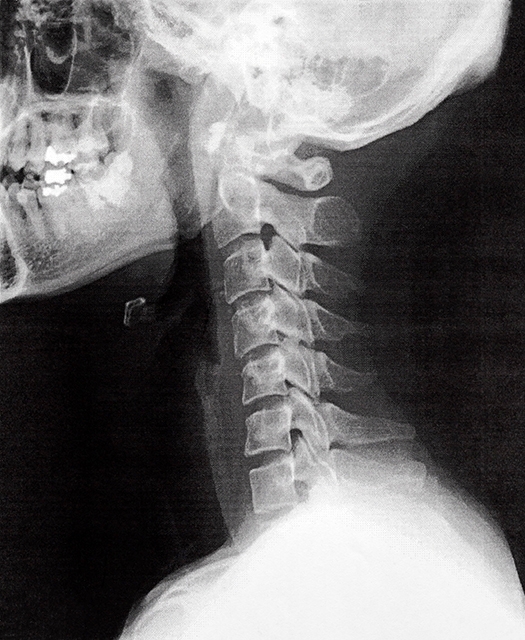 頸部レントゲン撮影