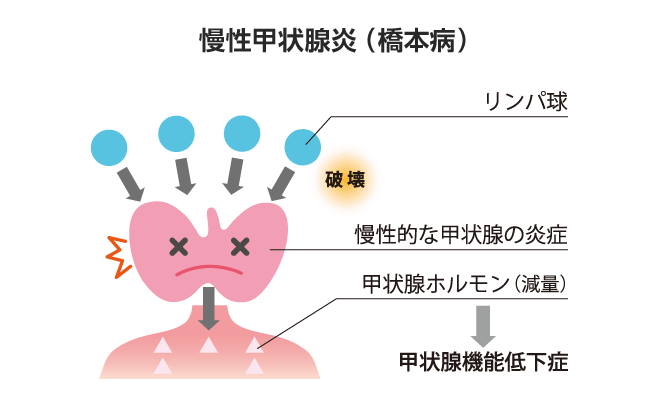 慢性甲状腺炎（橋本病） 甲状腺ホルモンが減る病気 甲状腺疾患辞典 KUMApedia 甲状腺と病気の専門情報をお届け