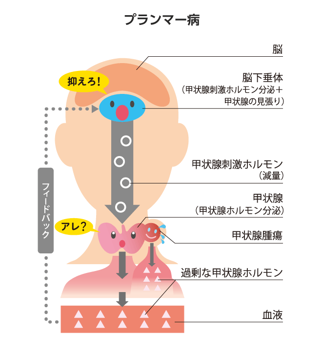 ん 症状 が 甲状腺 甲状腺自己チェック